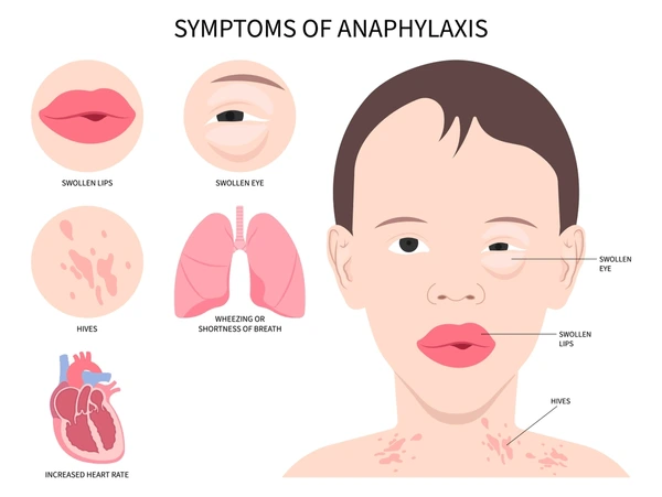 anaphylaxis allergy face swollen bee 600nw 2318159175